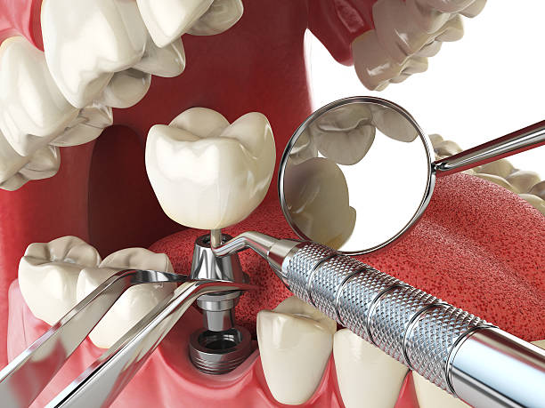Best Emergency Tooth Extraction in Santa Ana Pueblo, NM